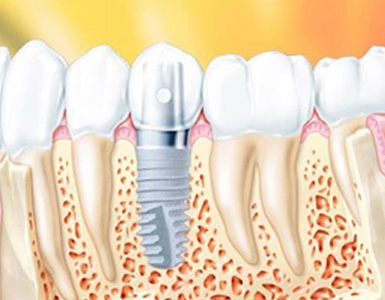 O que são implantes dentários?